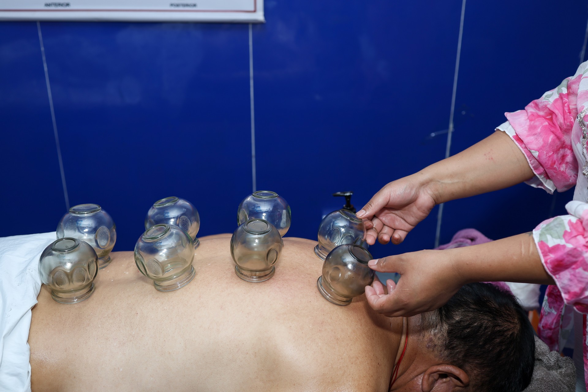 Cupping